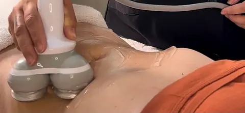 Ponteira do Híbridi aplicada no abdômen